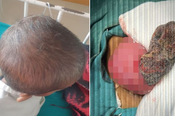 Dokter yang terkejut menemukan bola rambut besar dengan ‘ekor’ di perut seorang gadis berusia empat tahun Dokter yang terkejut menemukan bola rambut besar dengan ‘ekor’ di perut seorang gadis berusia empat tahun
