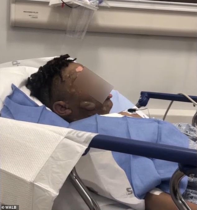 Seorang anak mengalami luka bakar yang parah setelah temannya mengerjainya saat dia tidur Seorang anak mengalami luka bakar yang parah setelah temannya mengerjainya saat dia tidur